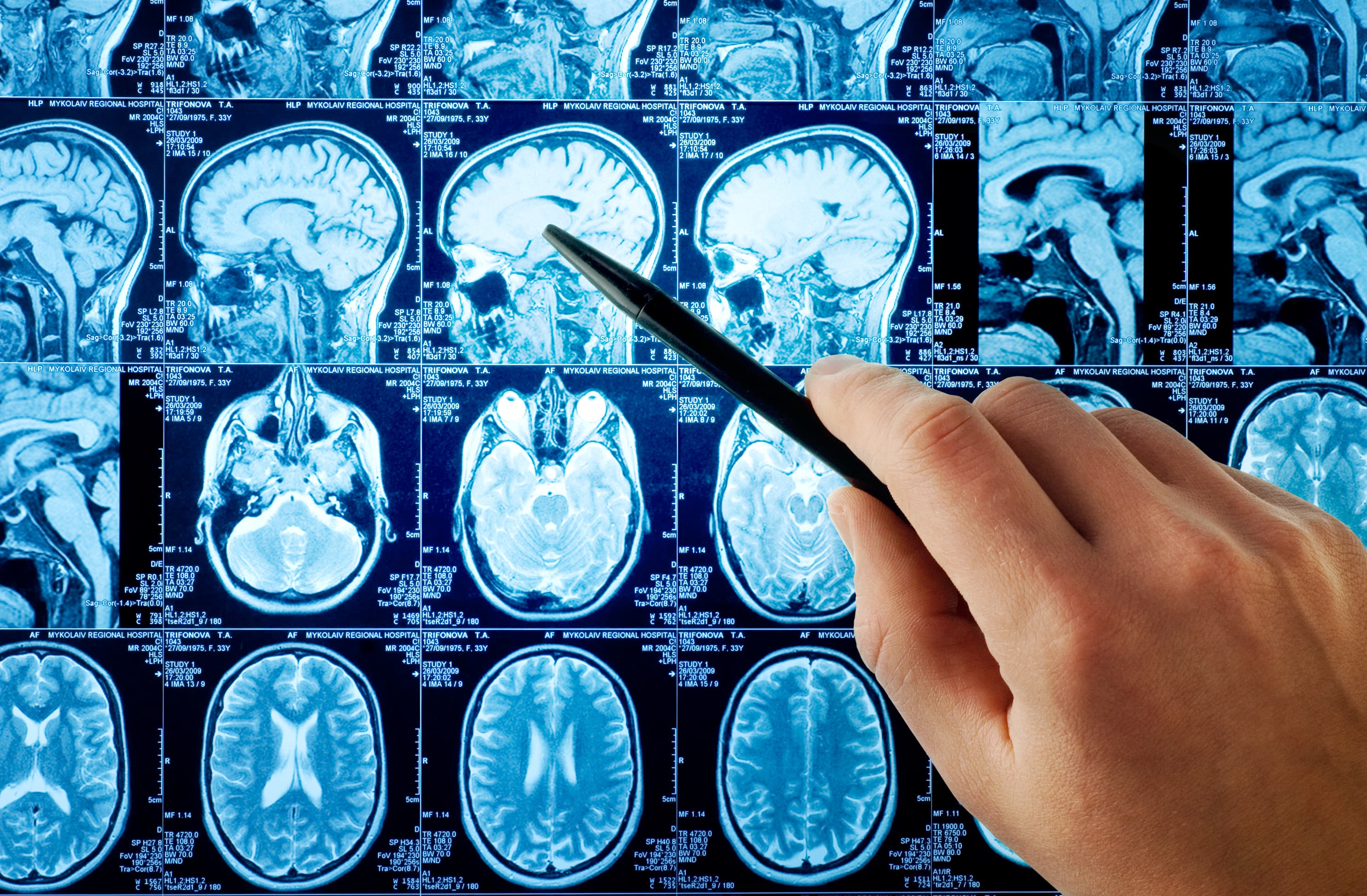 MRI,brain