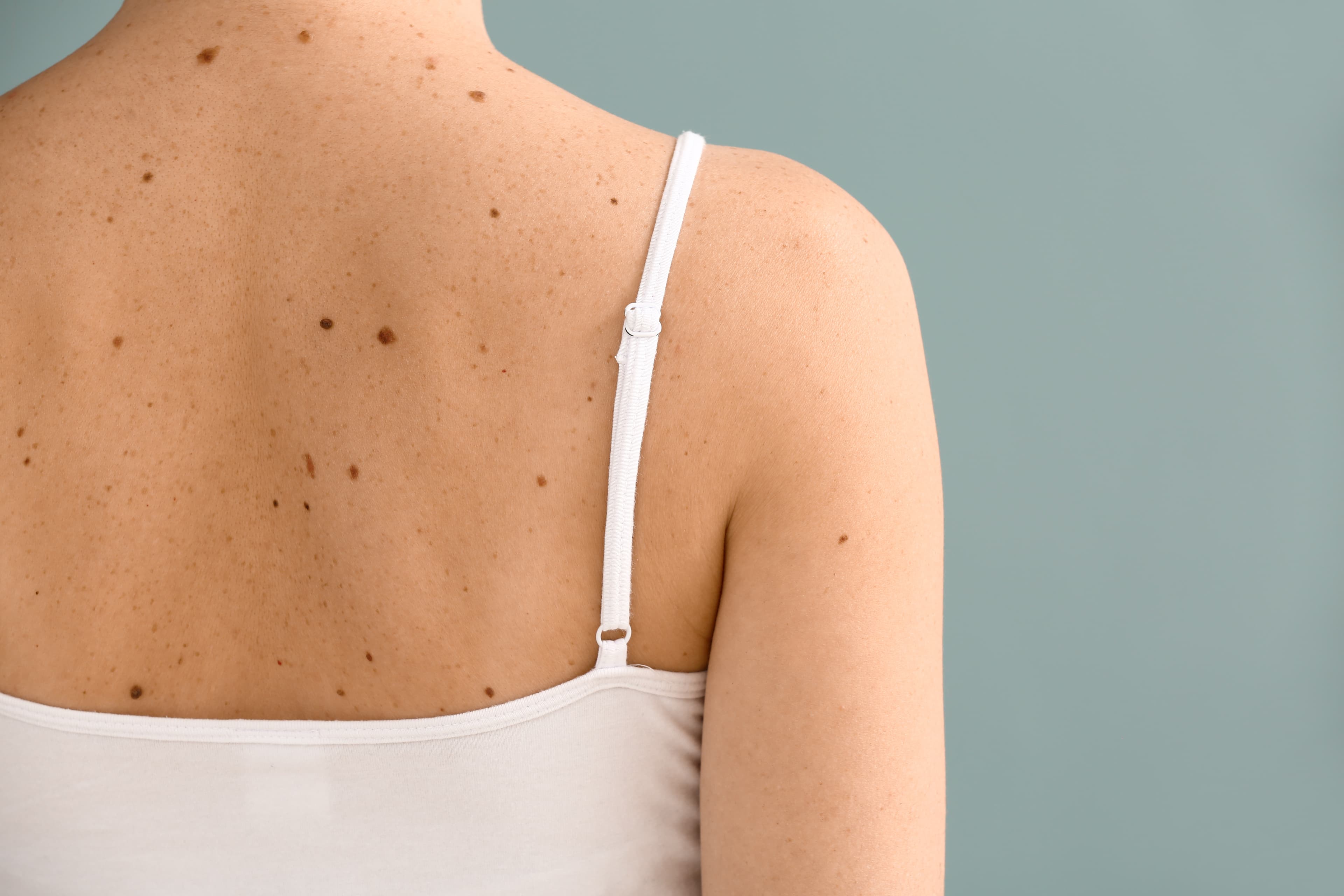 Young woman with moles on grey background
