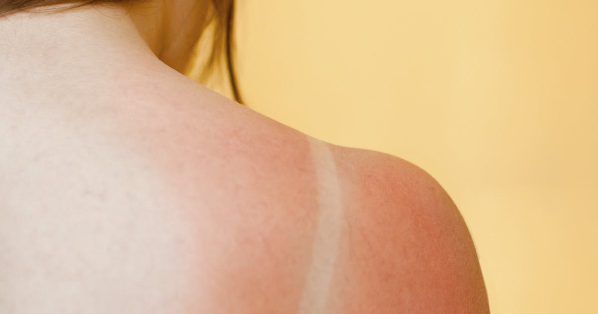 A woman's sunburned shoulder.