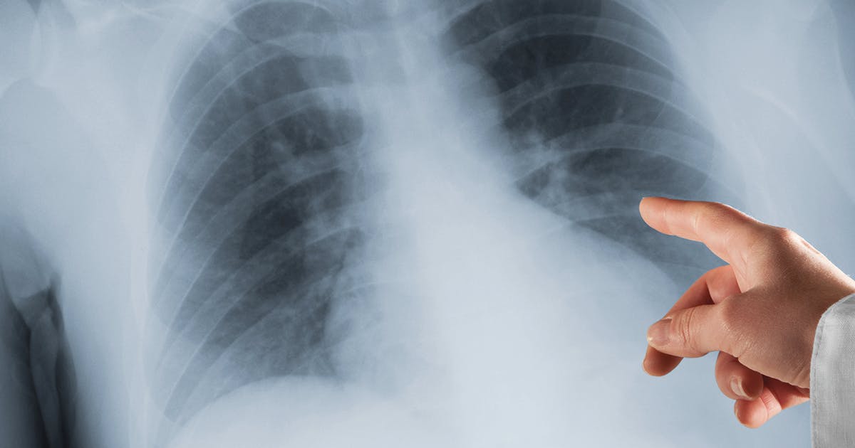 A person pointing at a x-ray of a chest.