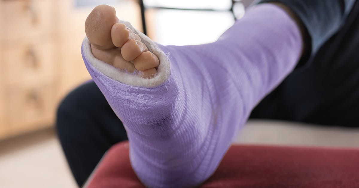 A man's ankle and foot in a cast.